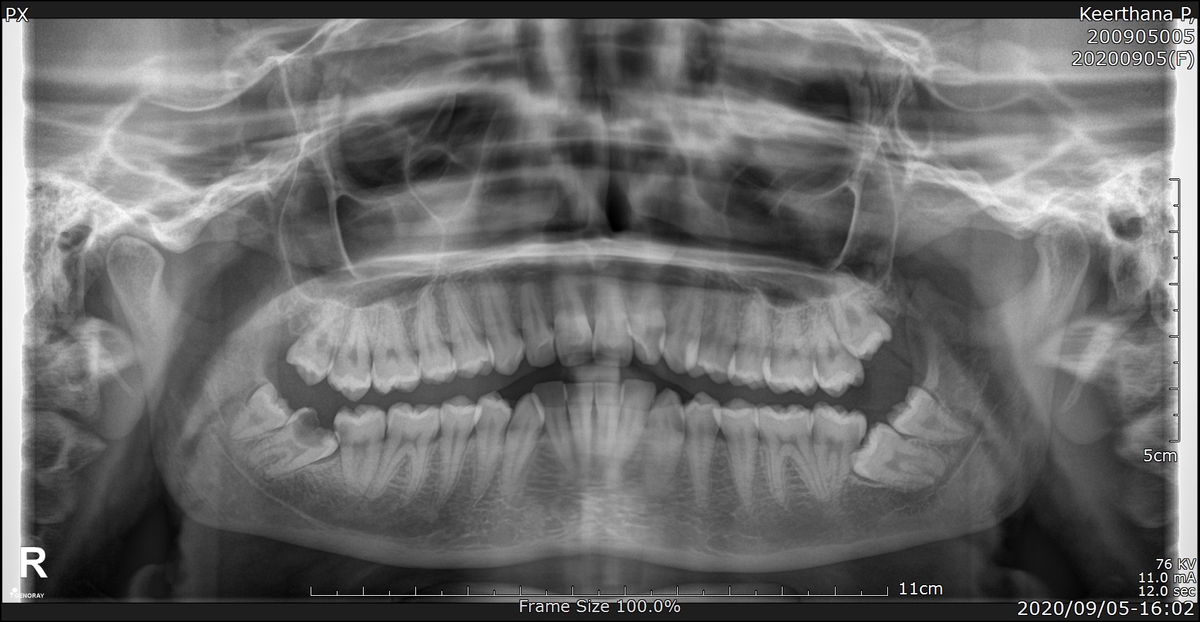 wisdom teeth removal in guntur