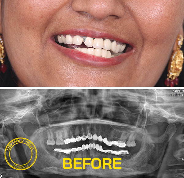 Confydentz Tilted Implants ; All on X case reports