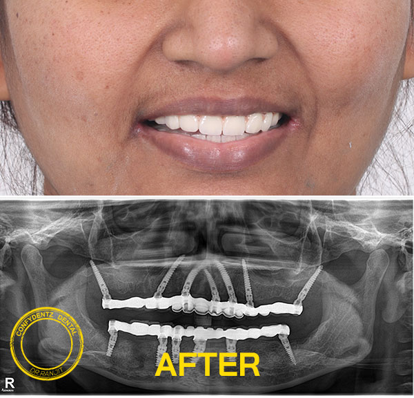 Confydentz Tilted Implants ; All on X case reports